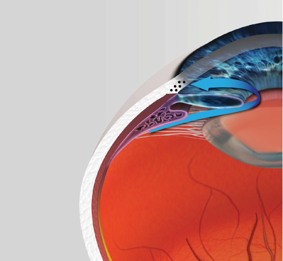 Cataracts and glaucoma