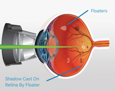 eye surgery to remove floaters