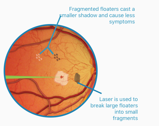 floaters after laser eye surgery