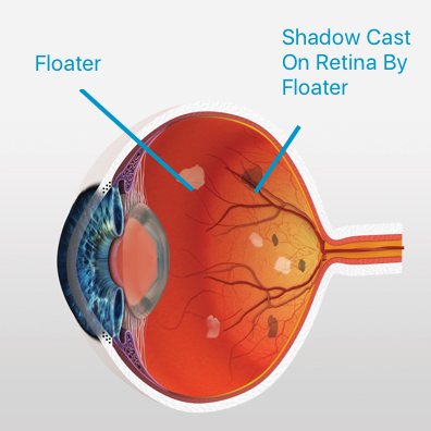 What causes floaters?