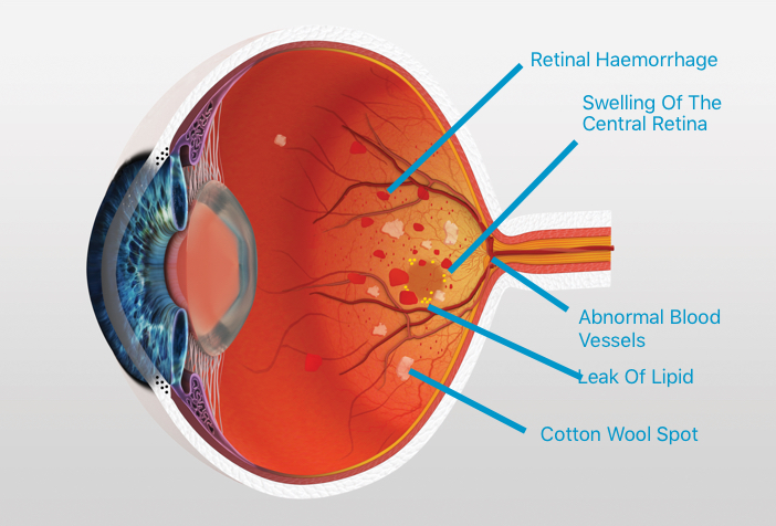 Treatment For Diabetic Retinopathy