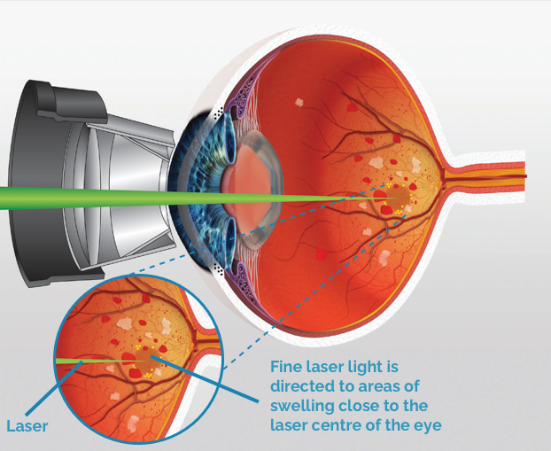 laser floater removal