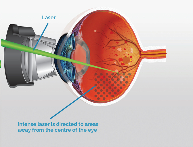 laser eye surgery to remove floaters