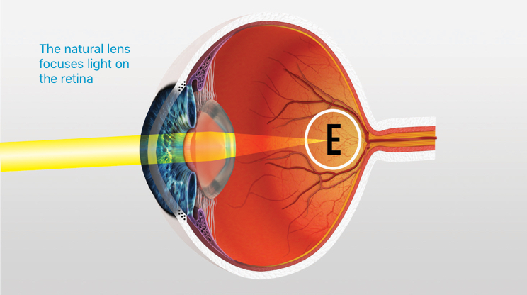 macular degeneration treatment australia