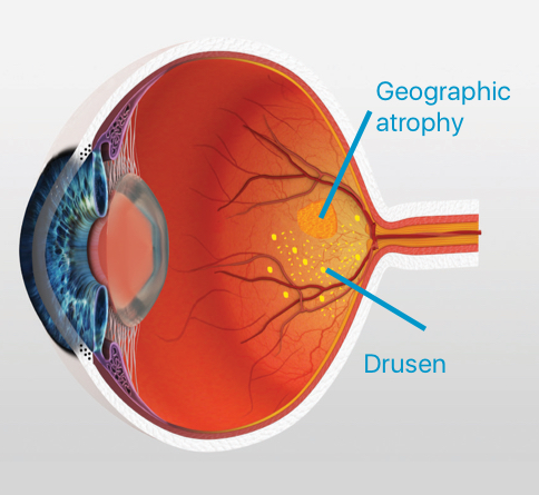 macular degeneration treatment australia