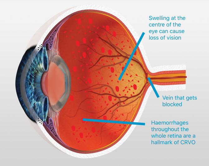 Vein Occlusion