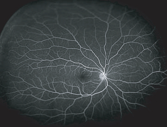 Fundus Fluorescein Angiography