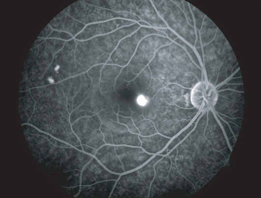 Fundus Fluorescein Angiography