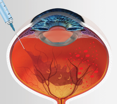 eye injections melbourne