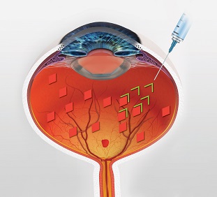 eyelid surgery melbourne