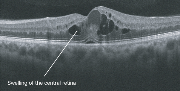 Diabetic Macular Oedema