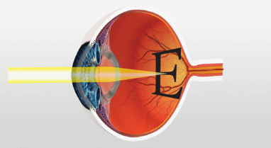 after cataract surgery