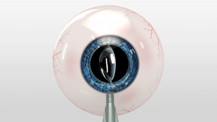 cataract eye surgery