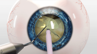 cataract surgery cost melbourne