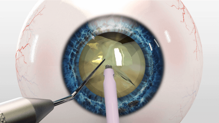 cataract surgery procedure