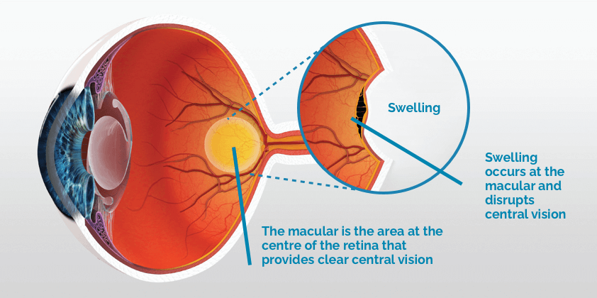 cystoid macular edema post cataract surgery