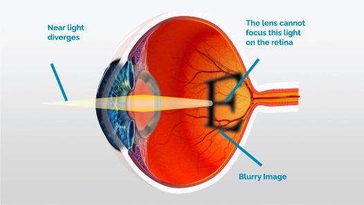 presbyopia cataract surgery