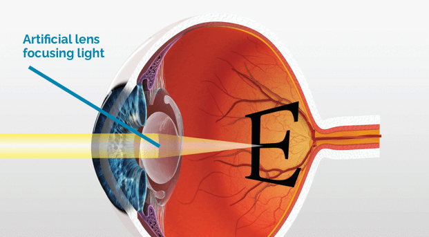 presbyopia causes