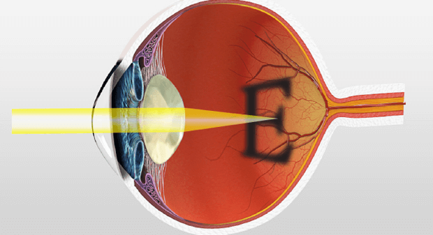 what is cataract surgery