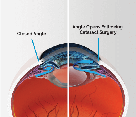 glaucoma angle closure treatment