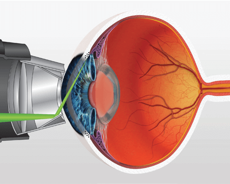 glaucoma laser surgery melbourne