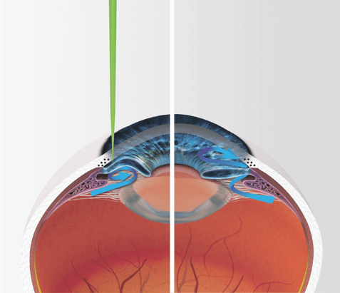 glaucoma laser treatment