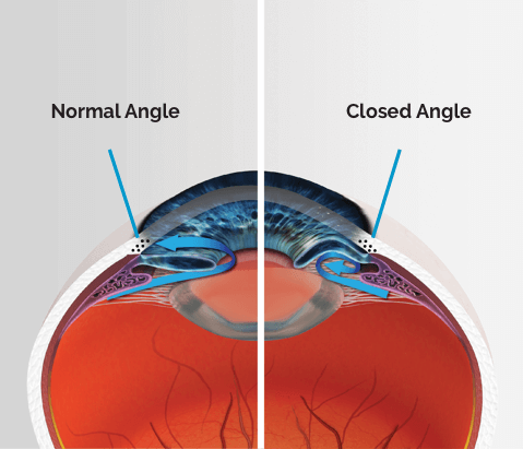 glaucoma primary angle closure