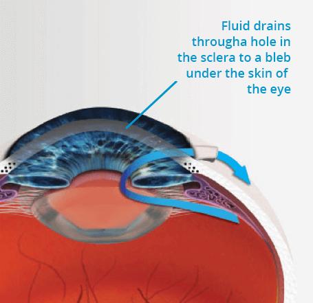 glaucoma tube surgery benefits