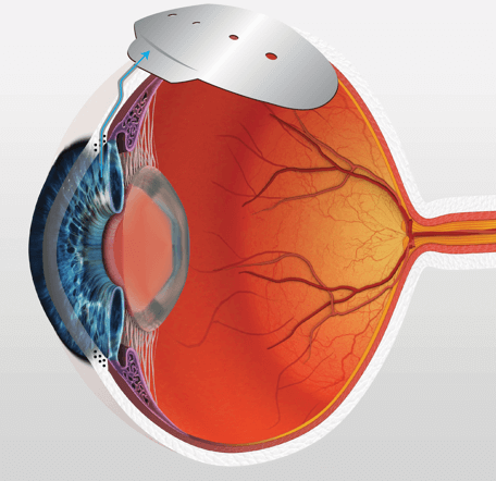 melbourne glaucoma surgery