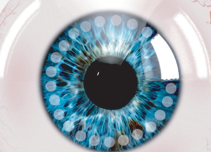 plateau iris glaucoma treatment