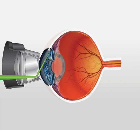 selective laser trabeculoplasty